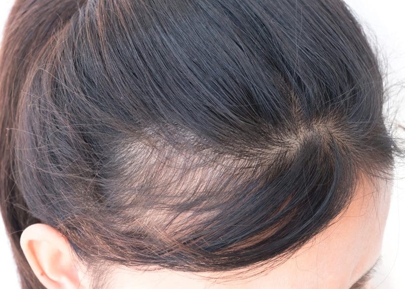 AHI-Clinic_Blog_Woman-Hair-loss