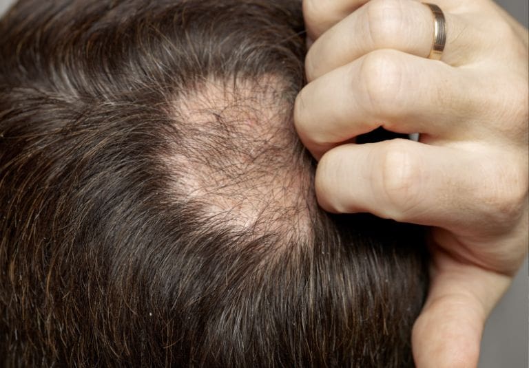 Is a Hair Transplant Painful? AHI Clinic Hair Transplant Clinic London