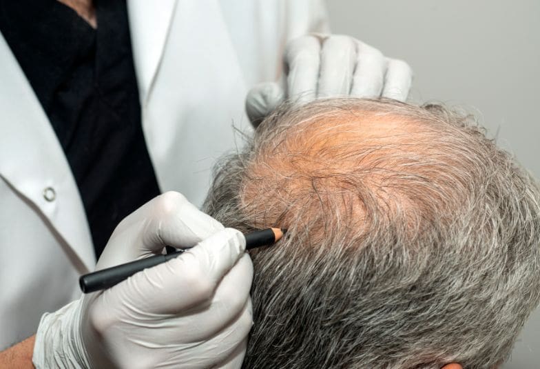 Guide to Hair Transplant AHI Clinic